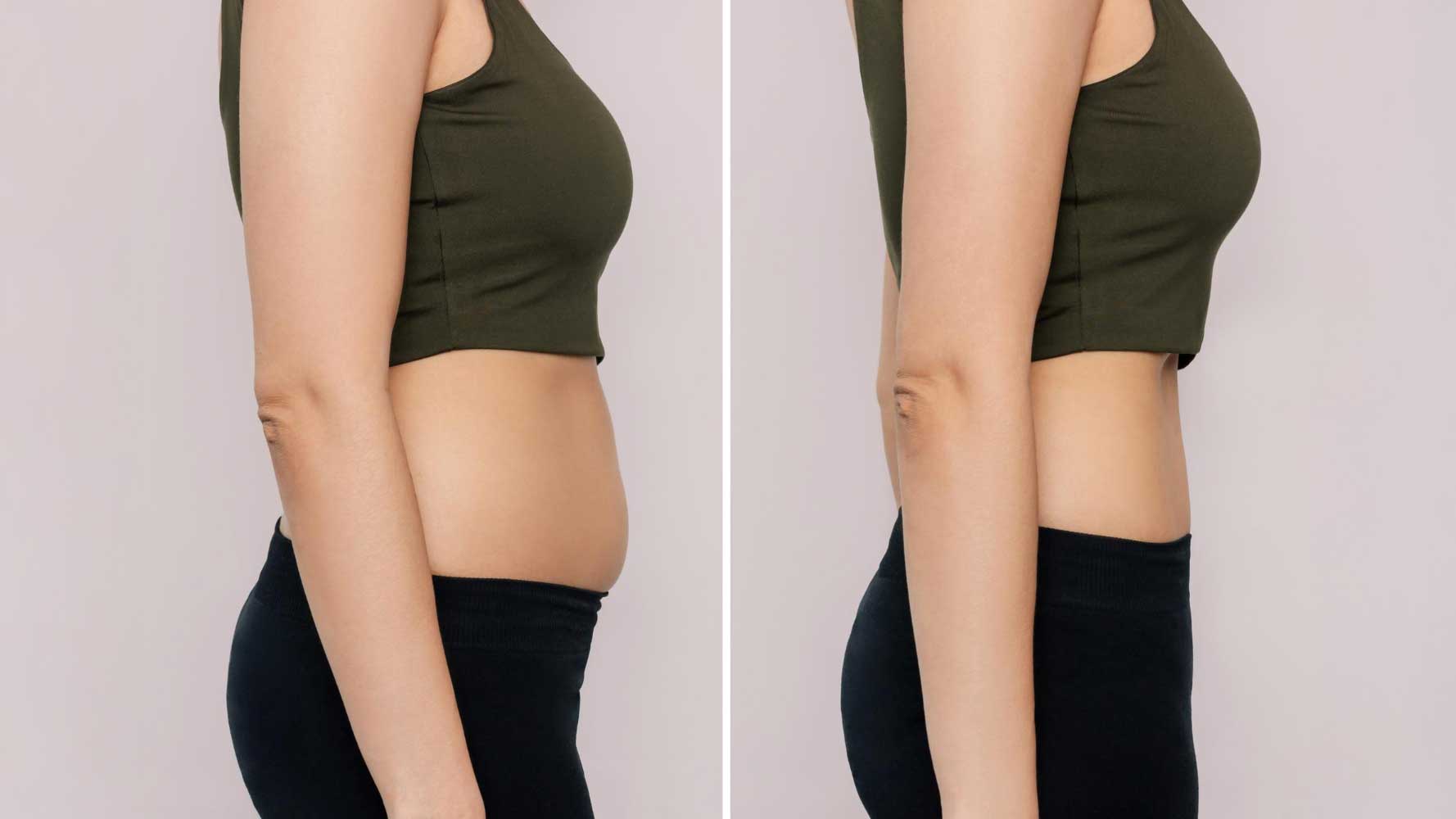 أنواع شفط الدهون: أيها الأنسب لك؟