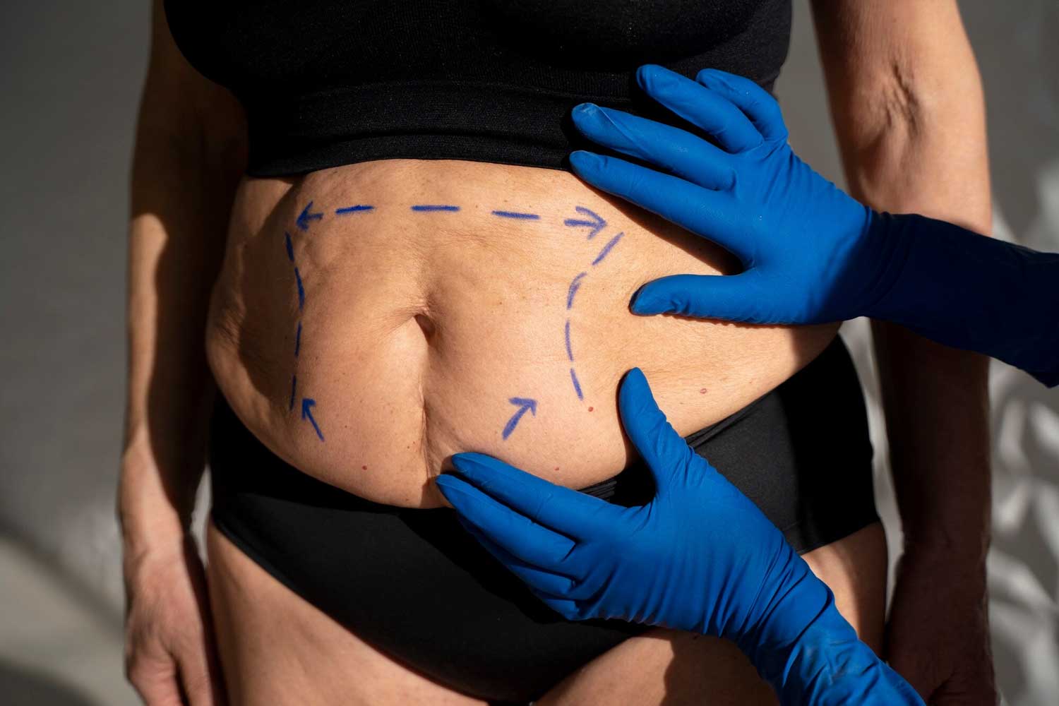 Everything You Need To Know About Liposuction