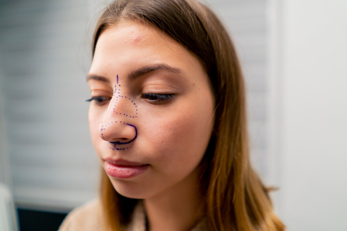 Exploring the Aesthetic Goals for a Crooked Nose Correction
