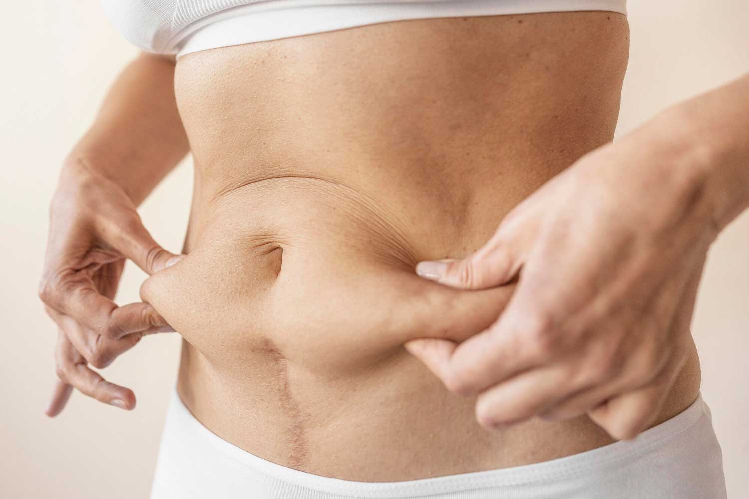 Liposuction or Tummy Tuck? What’s Right For You?