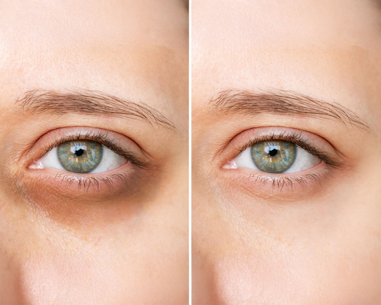 Dark Circle Procedure