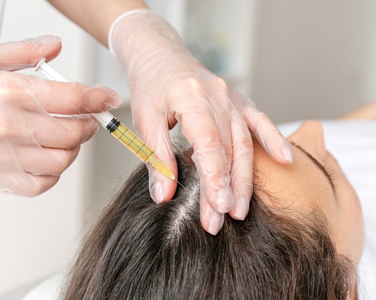 Botox Hair Loss Treatment