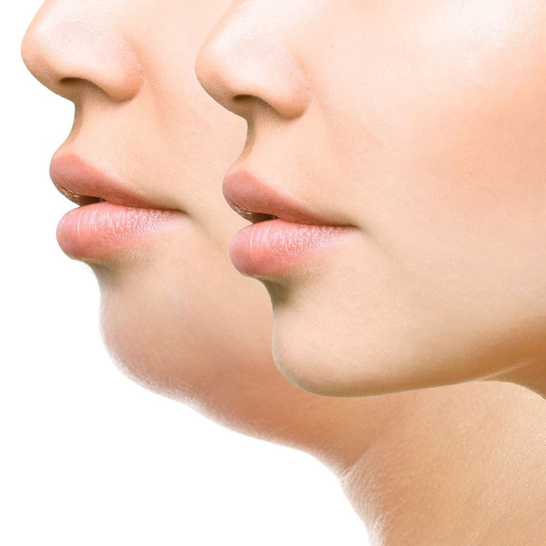 Jawline Contouring