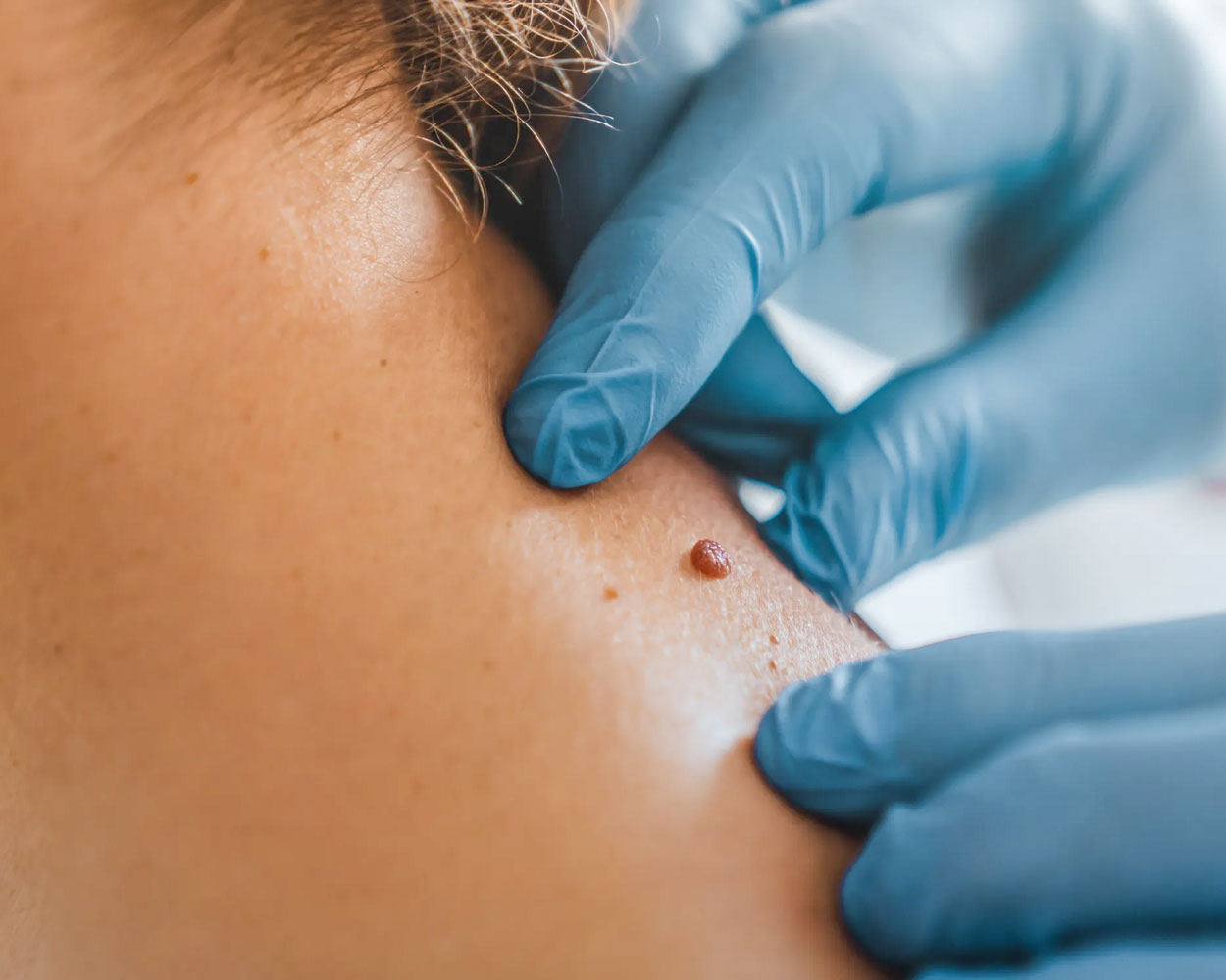 Medical or Surgical Mole Mapping