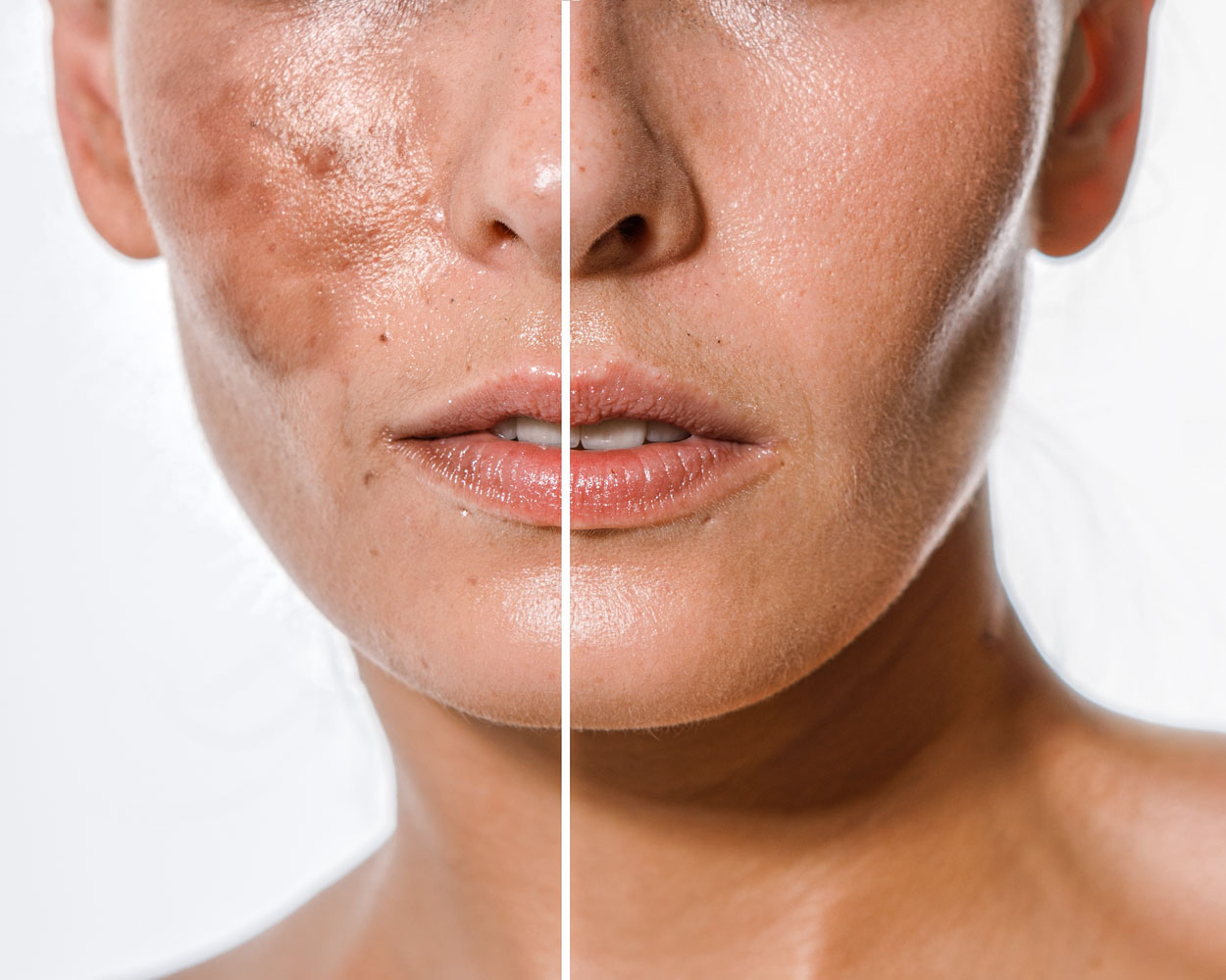 Melasma Treatment