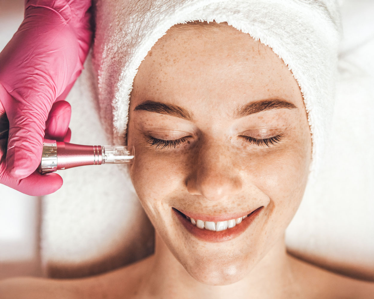 Microneedling