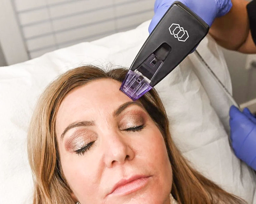 Morpheus 8 Procedure