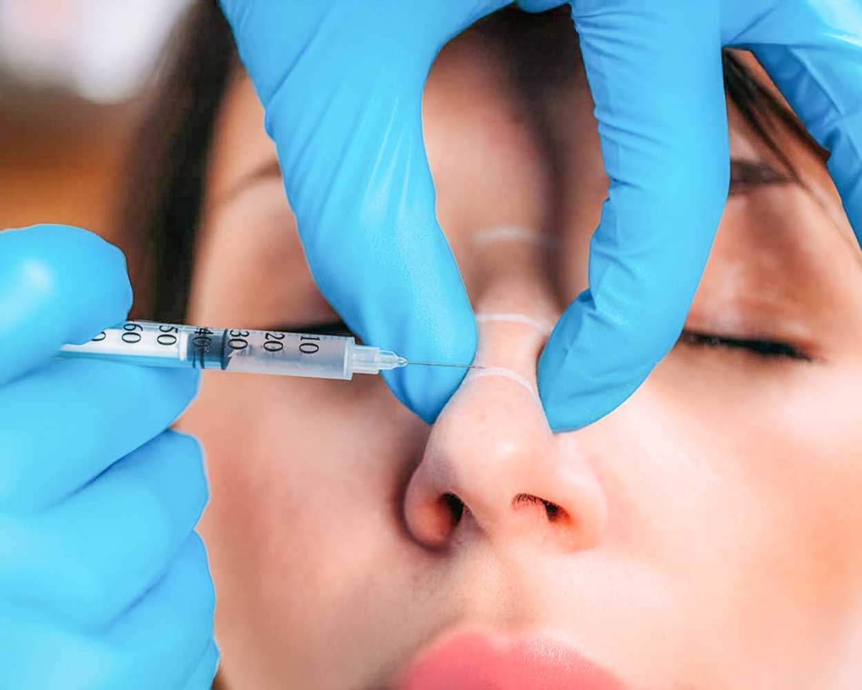 Non-Surgical Nose Reshaping