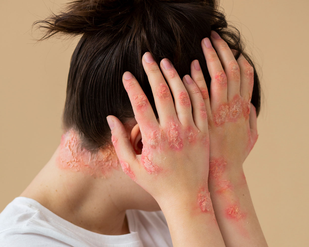 Psoriasis Treatments