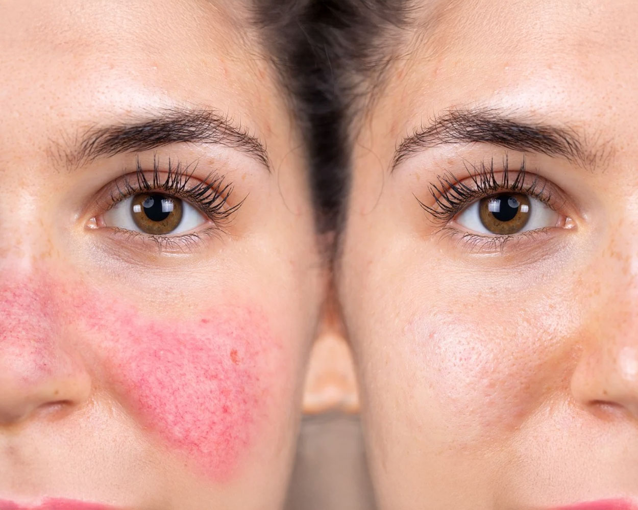 Rosacea Treatment