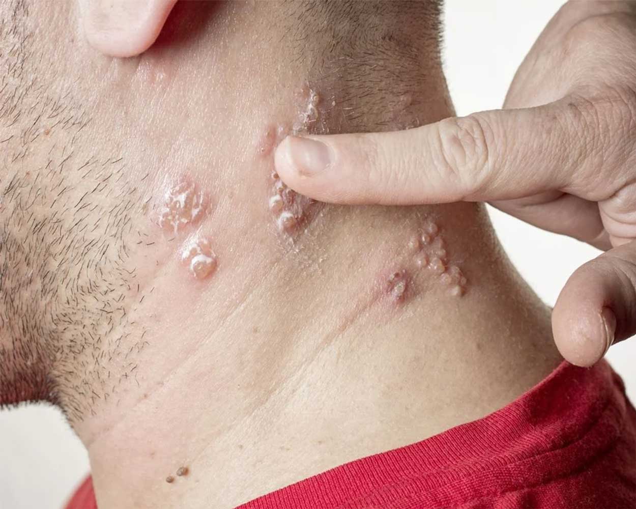 Skin Infections Treatment