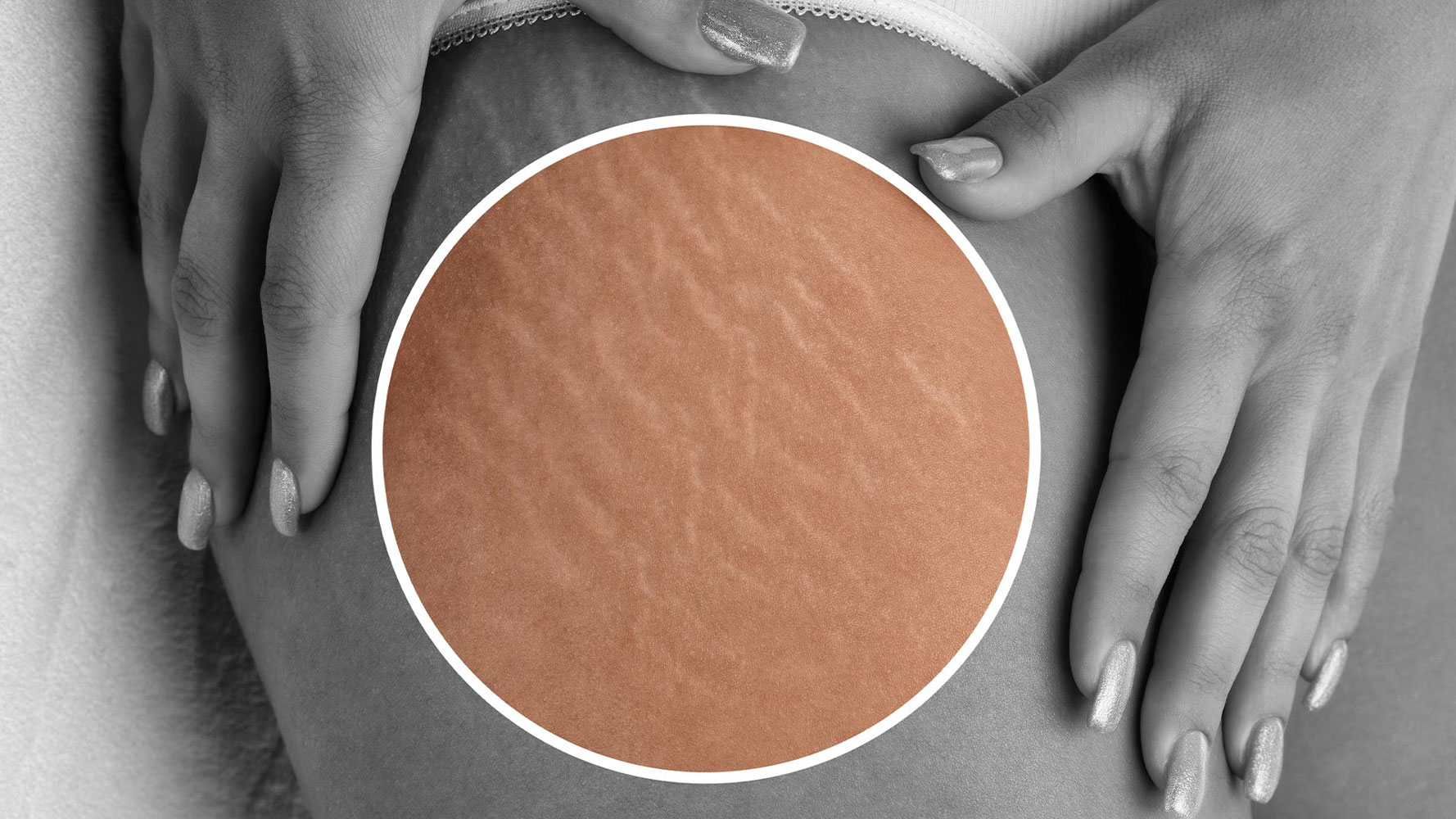 Stretch Marks Treatment