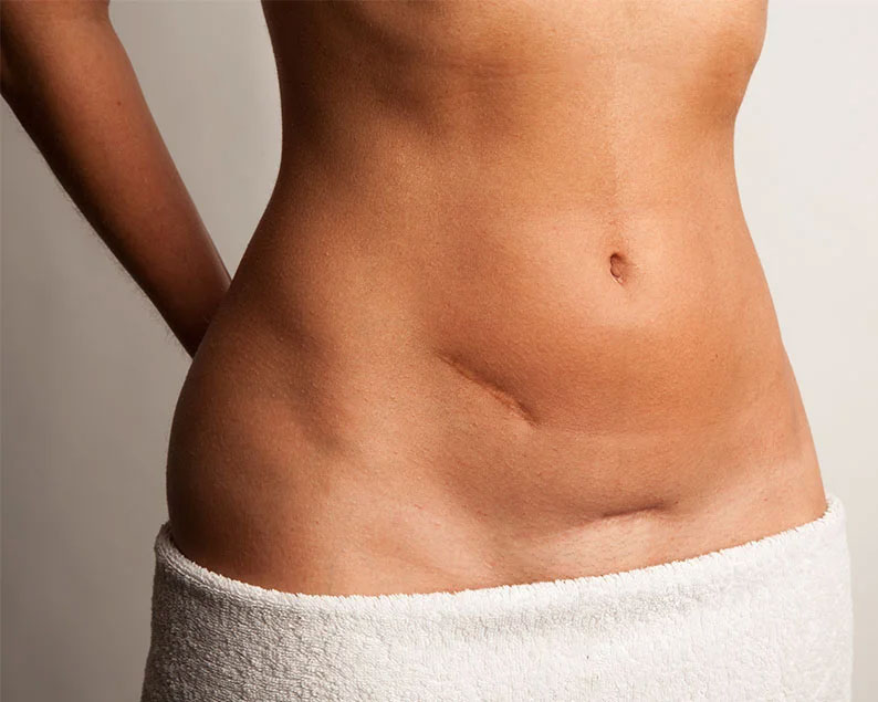 Surgical Scar Treatment