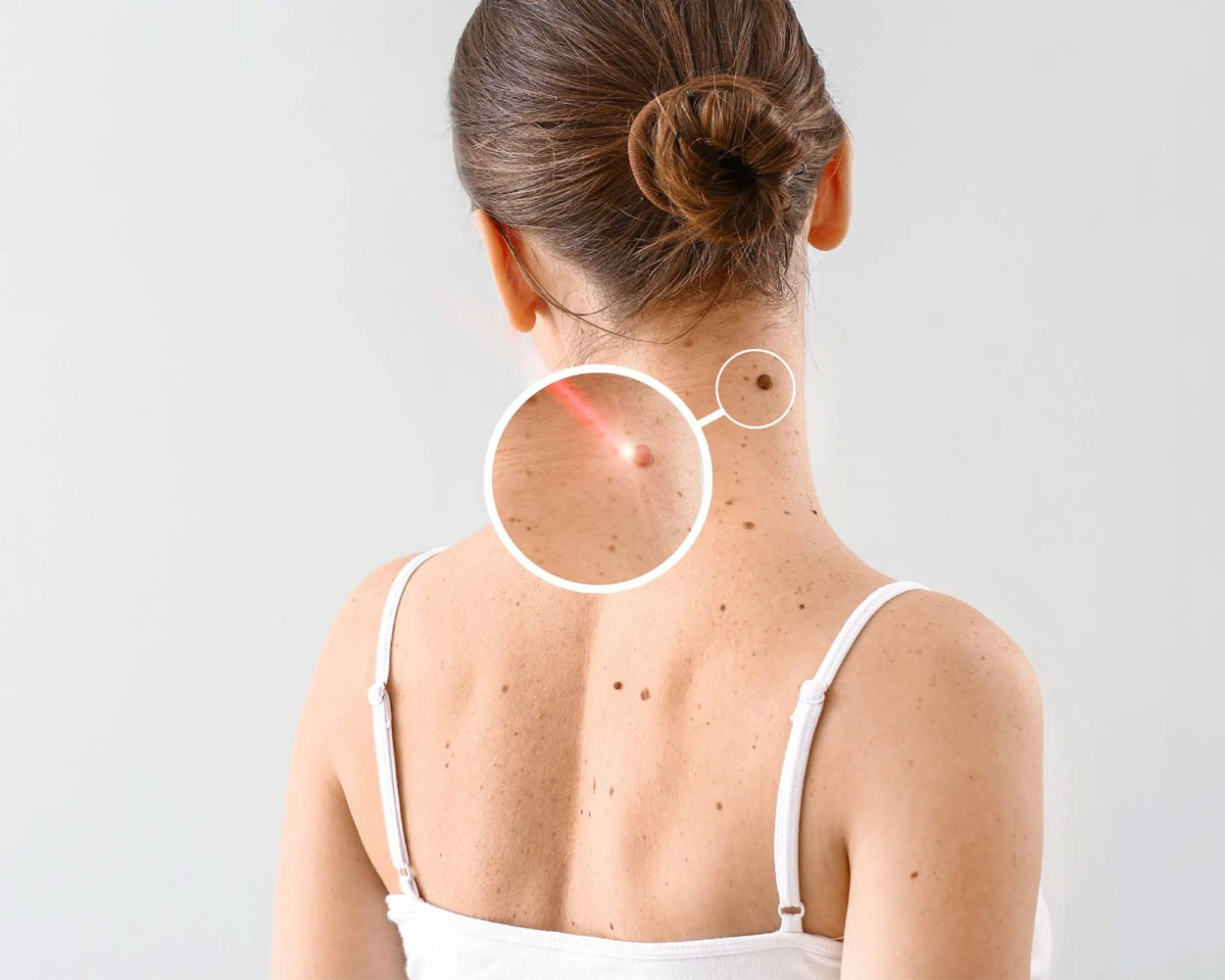 Warts Removal Treatment