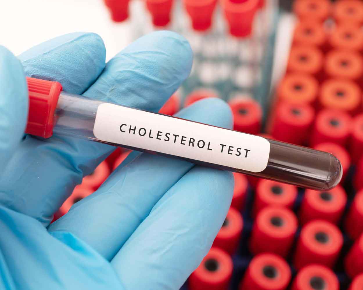فحص الكوليسترول
