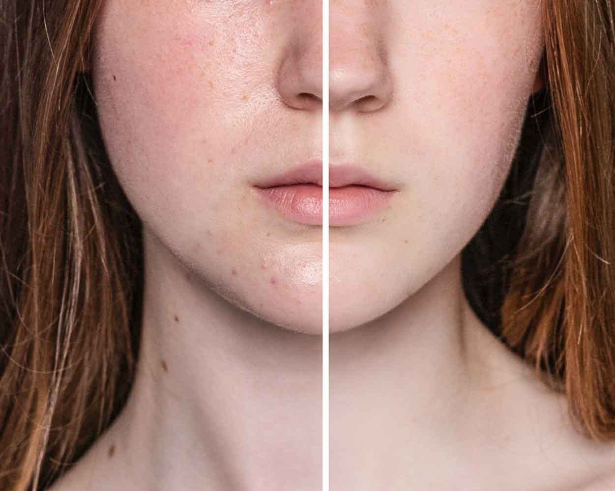 Laser Treatment for Dark Spots