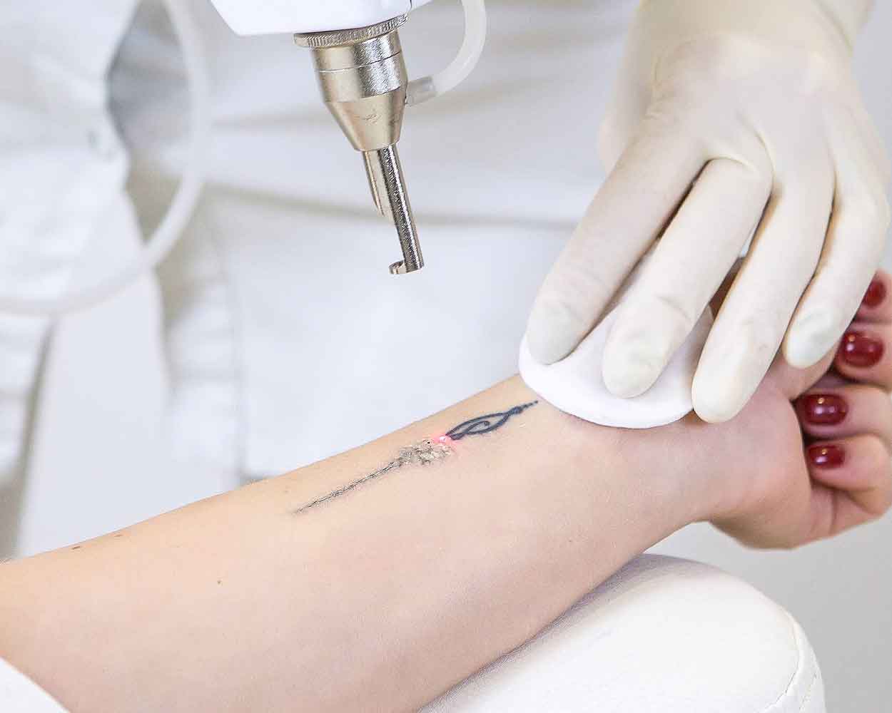 Tattoo Removal