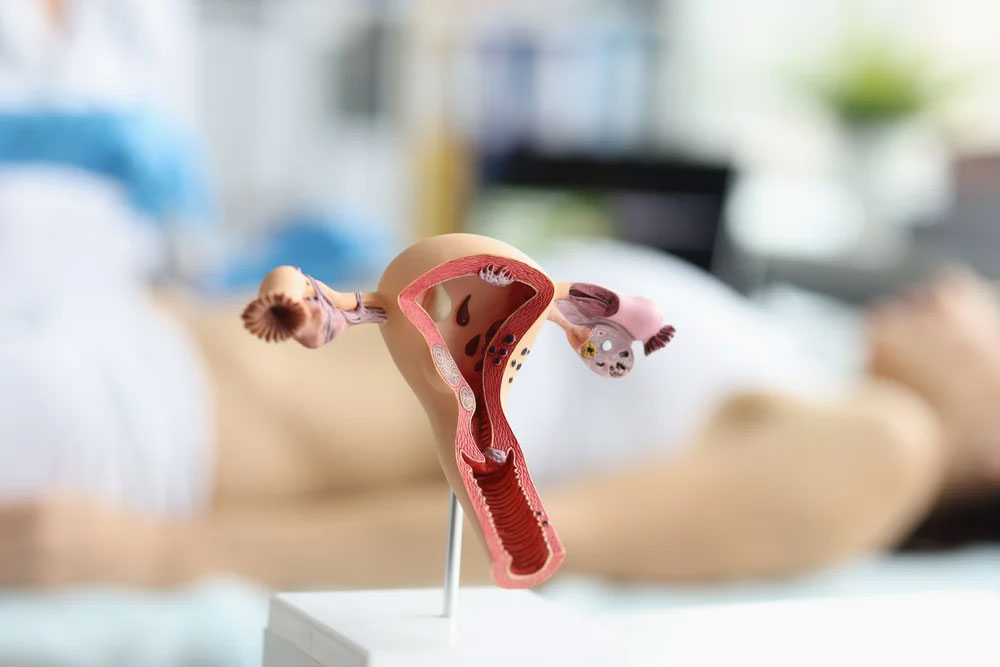 Adnexal Mass Treatment