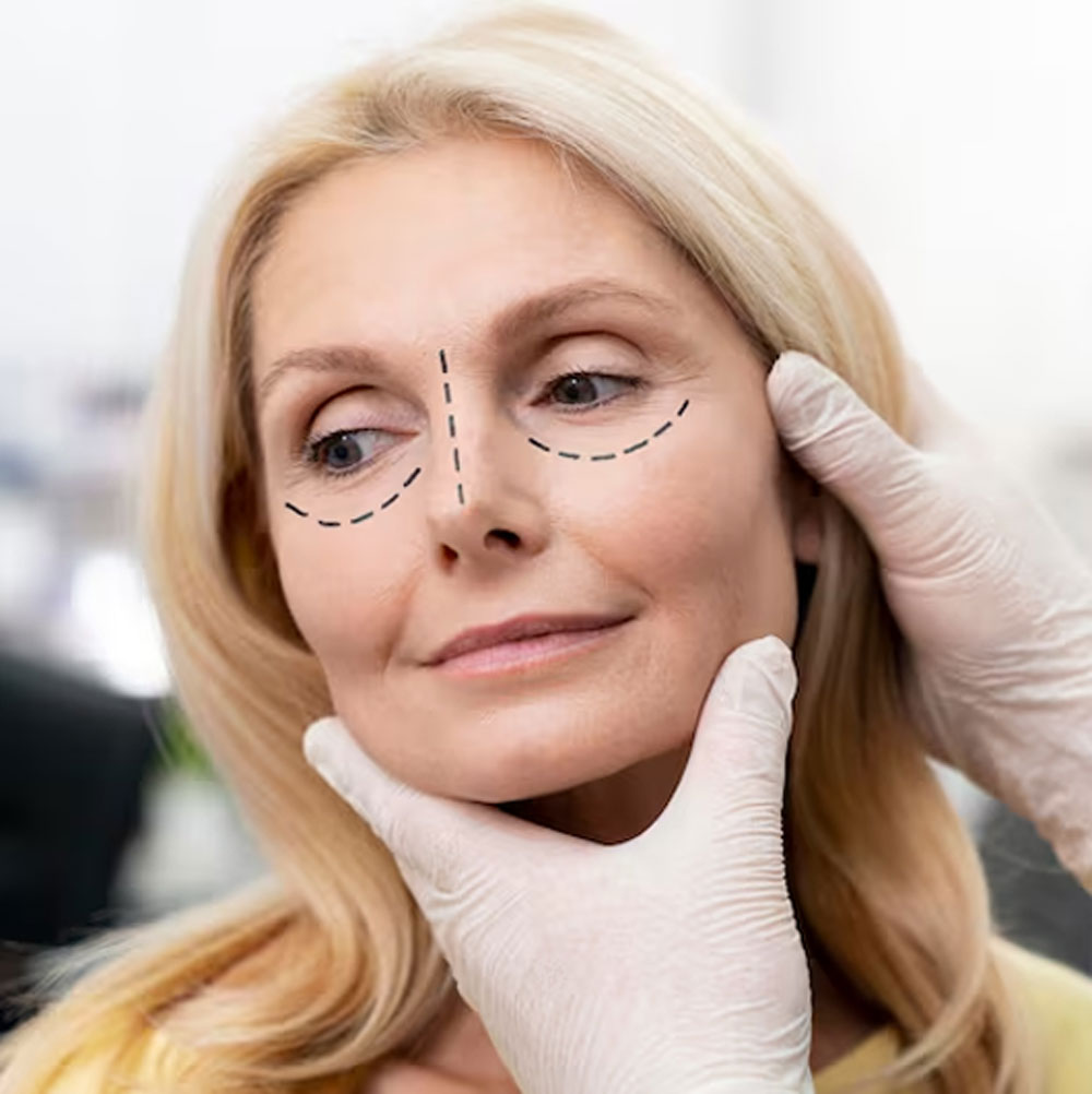 Blepharoplasty (Eyelid Lift Surgery) 