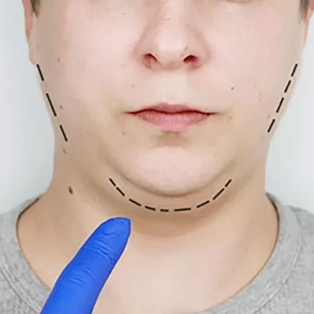 Chin Augmentation