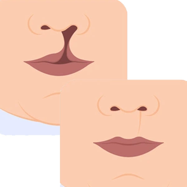 Cleft Lip and Palate Repair