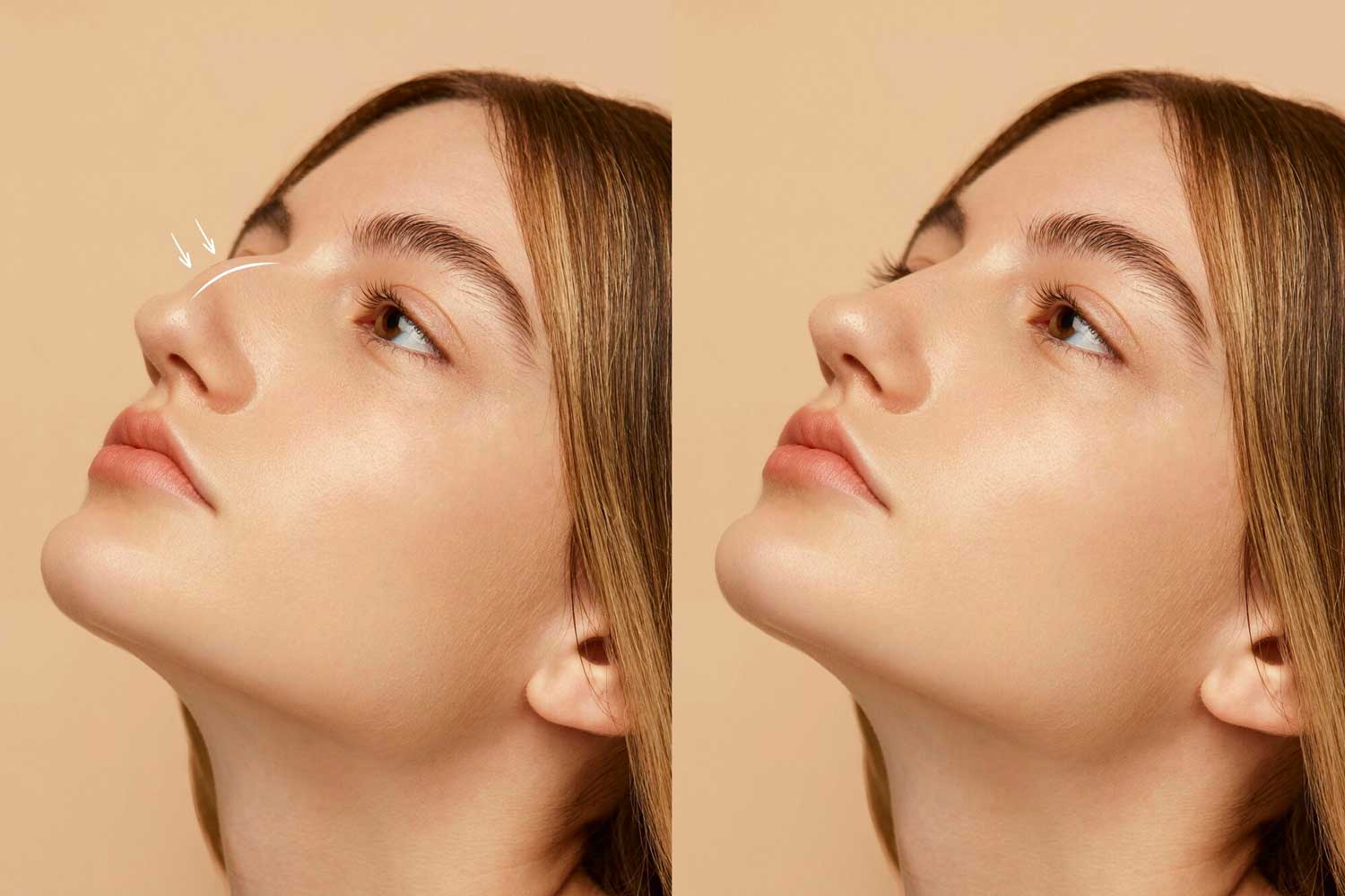 تجميل الأنف المغلق (تجميل الأنف بدون ندوب)