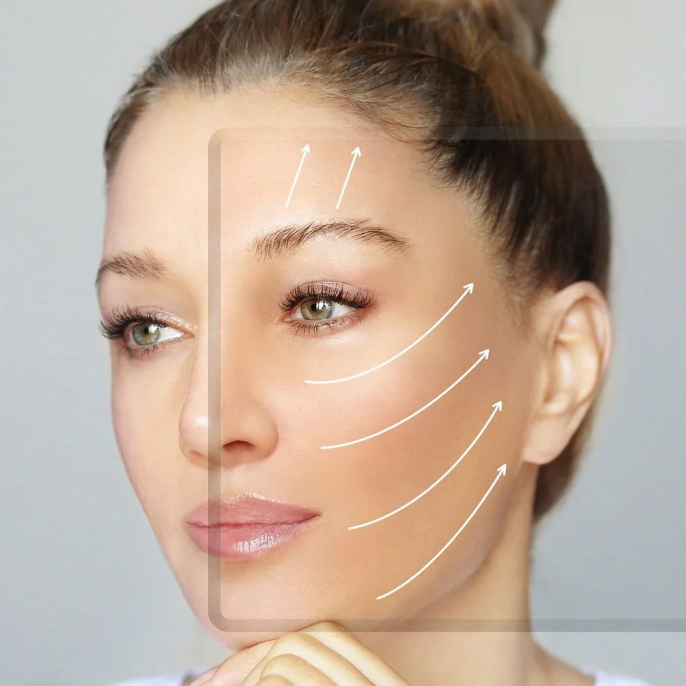 Facelift (Rhytidectomy)