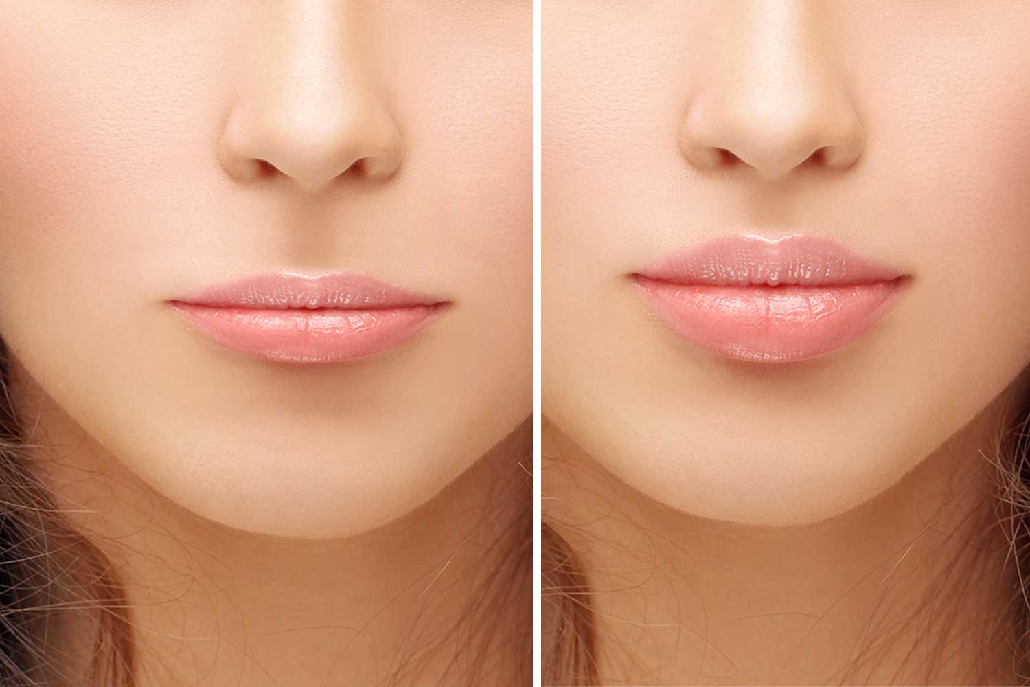 عملية رفع الشفاه