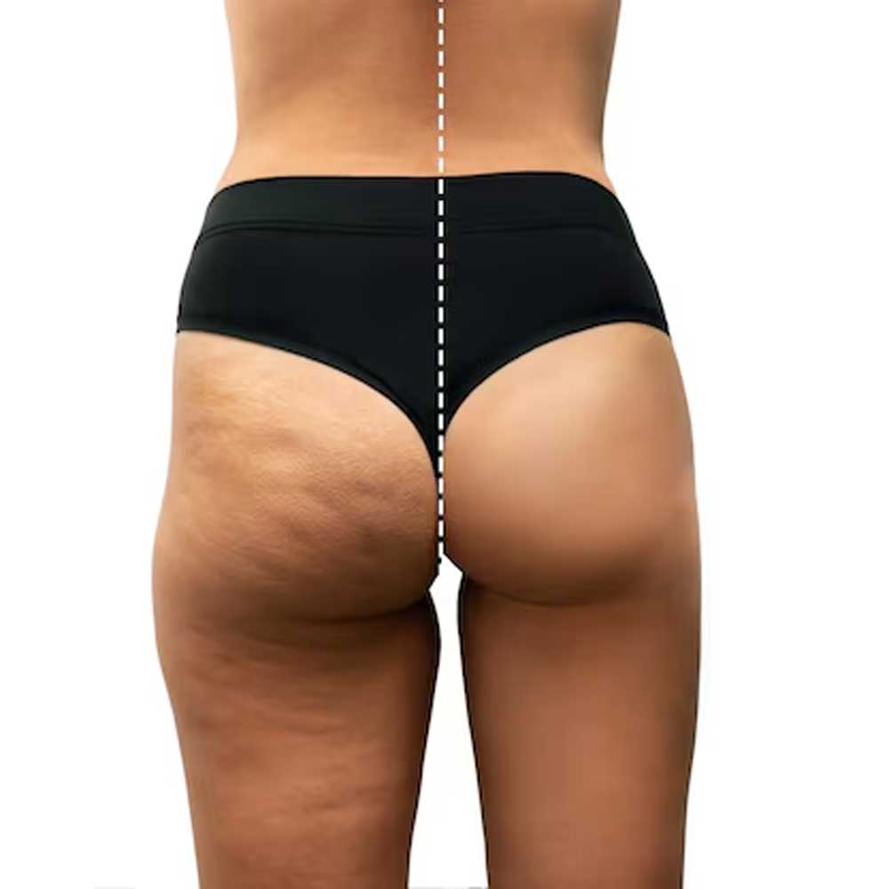 Lipedema