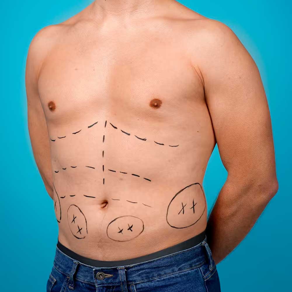 Male Body Contouring