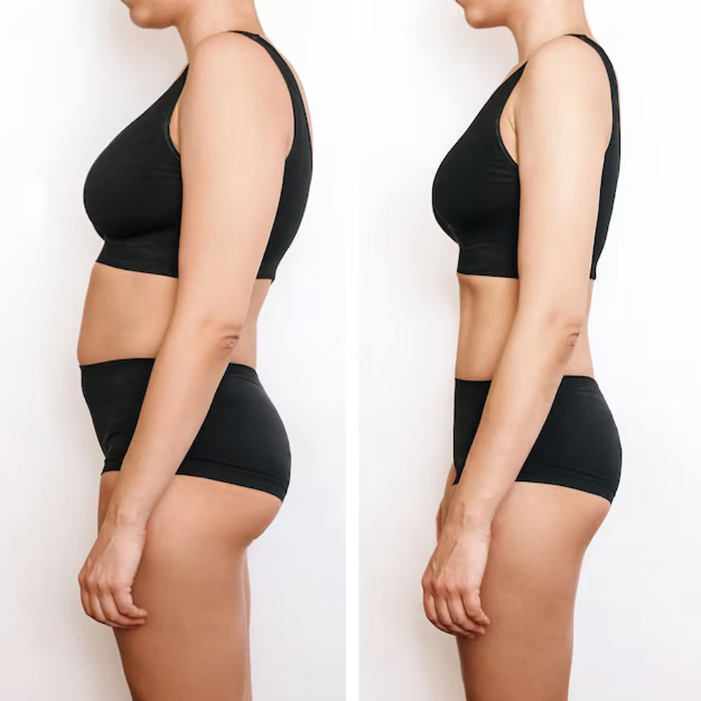 M.I.L.A. (Minimally Invasive Lipo-Abdominoplasty)