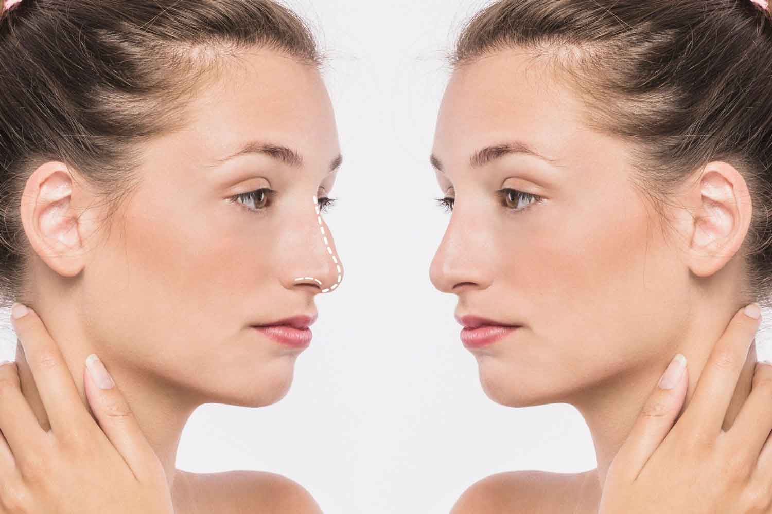 تقنية تجميل الأنف المفتوح