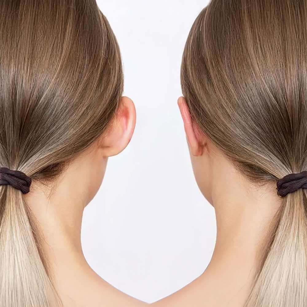 Otoplasty (Ear Reshaping)