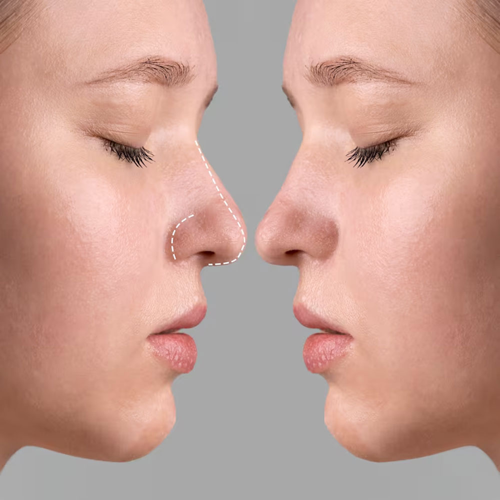 Rhinoplasty (Nose Job Surgery)