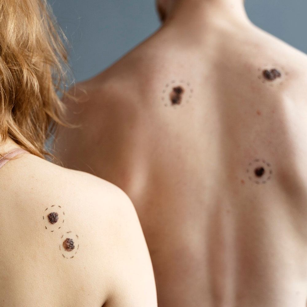 Skin Tumors & Scar Treatments