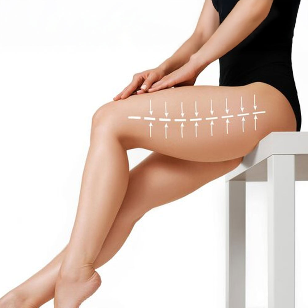 Thigh Lift (Thighplasty)