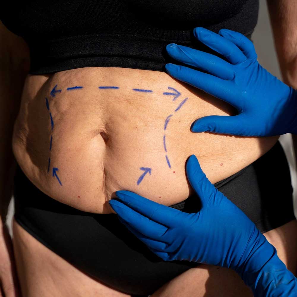 Tummy Tuck (Abdominoplasty)