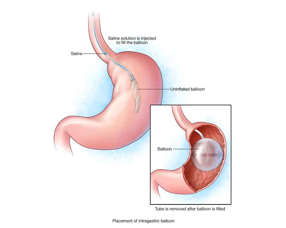 Gastric Balloon Procedure