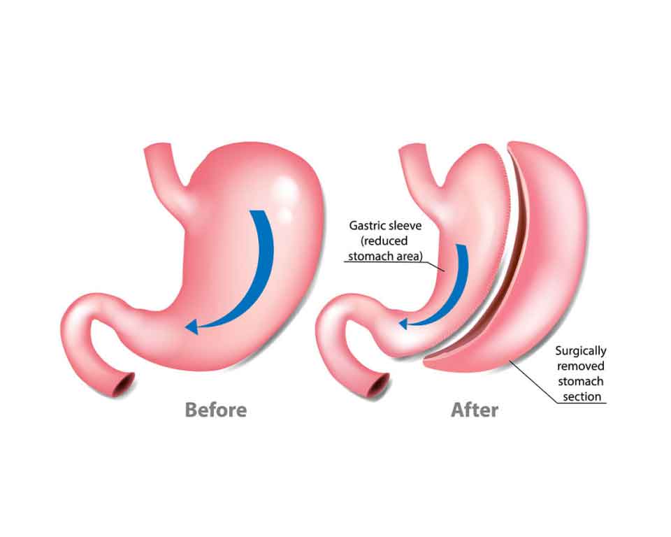 Sleeve Gastrectomy