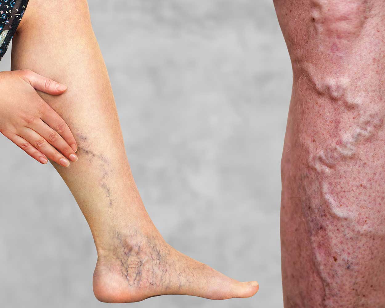 Arterial Revascularisation (Advanced Vascular Interventions)