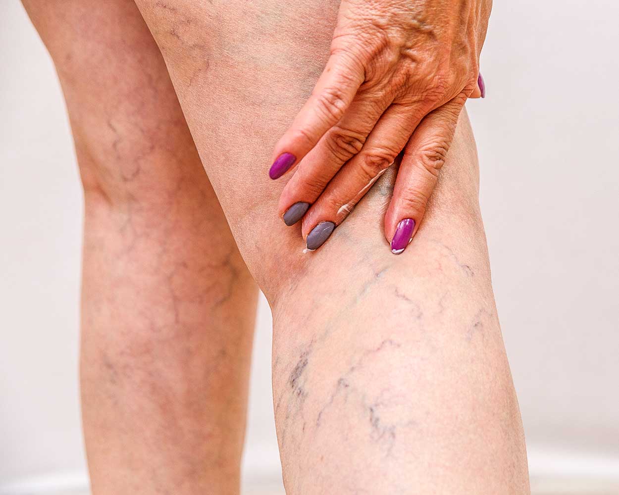 Dialysis Access (AV Fistula, AV Graft)