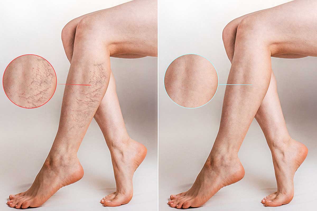 Leg Aesthetics & Circulation Improvement