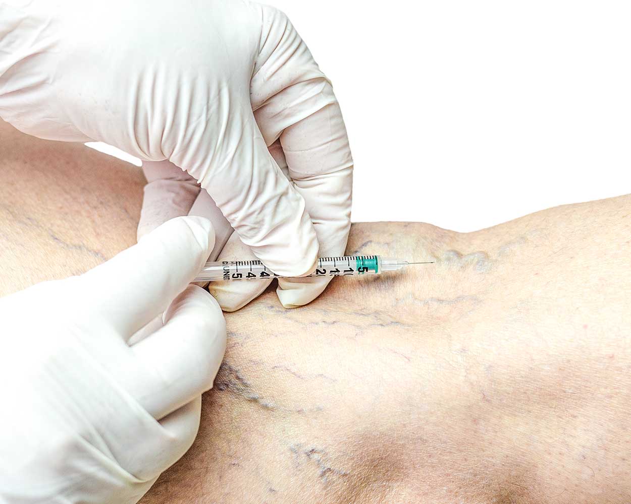 Sclerotherapy (Foam / Liquid)