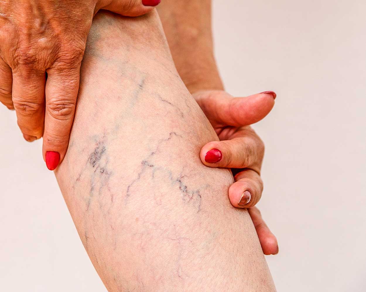 Varicose & Spider Veins Treatments