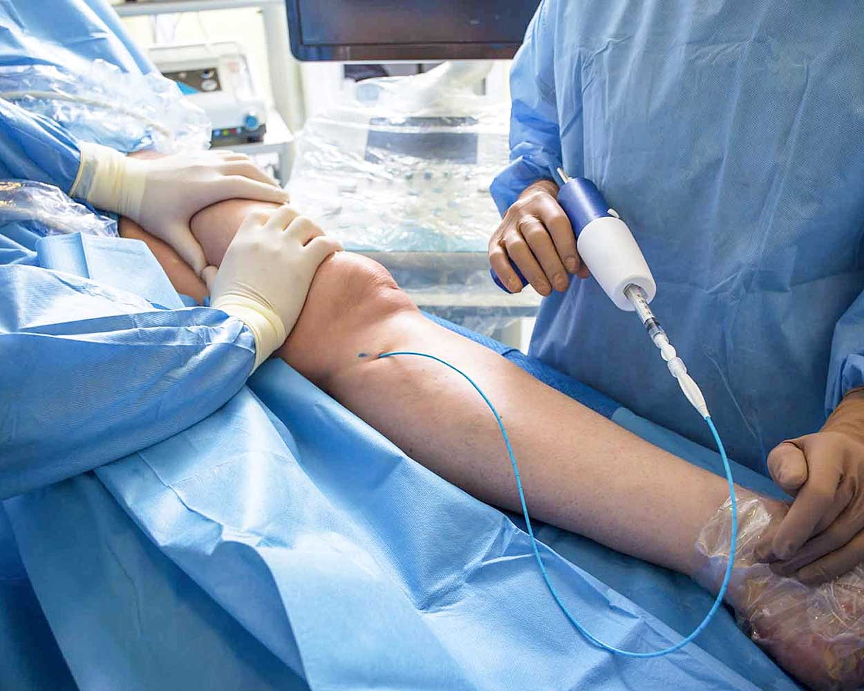 Vein Glue Closure (Cyanoacrylate)