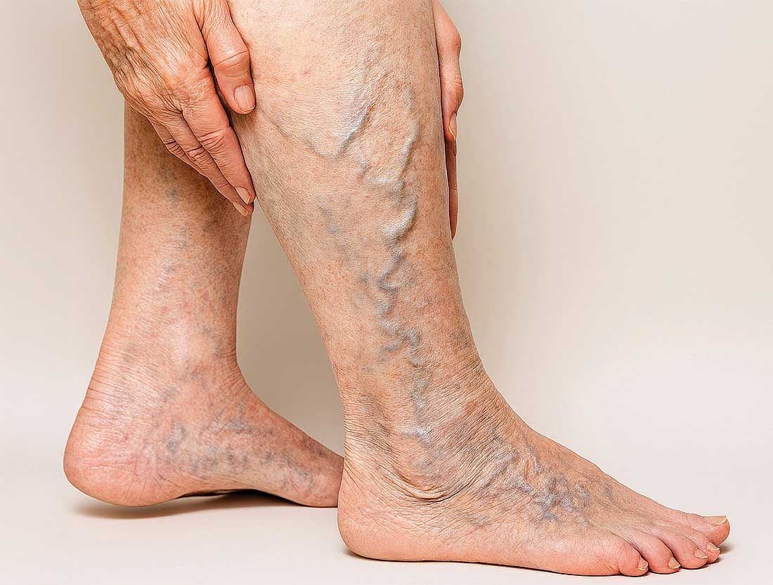 Venous Stenting (Advanced Vascular Interventions)