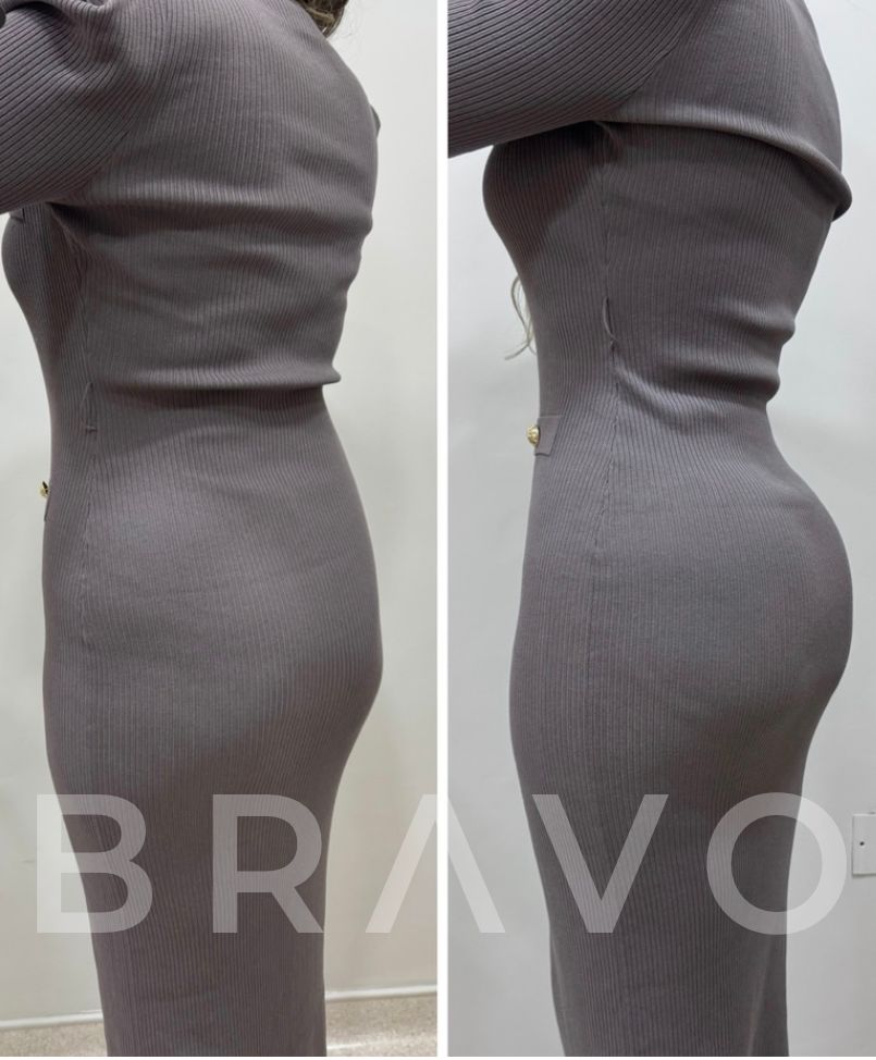 Dr. Miguel Bravo - Before & After Results 3