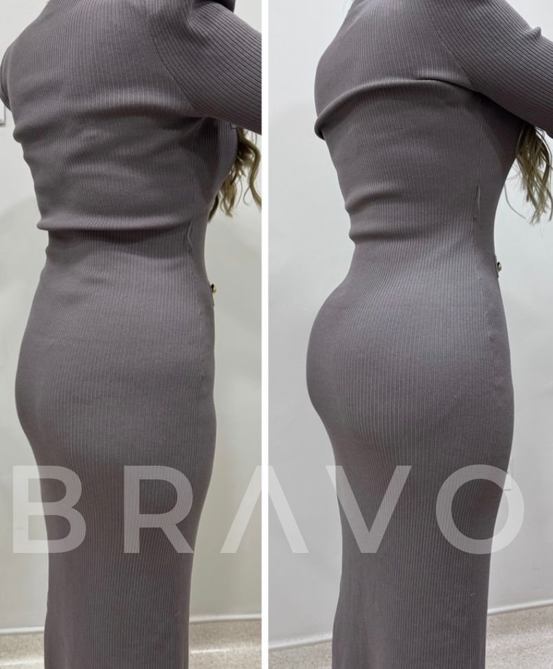 Dr. Miguel Bravo - Before & After Results 4