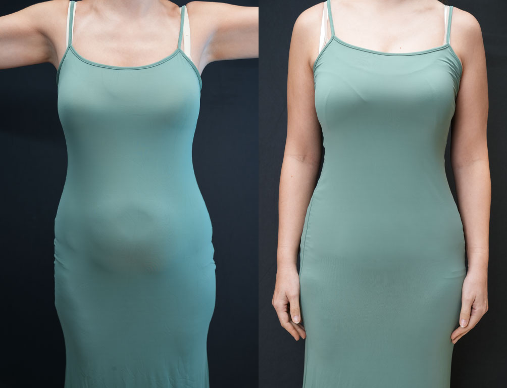 Dr. Mohammed Khamas - Before & After Results 1