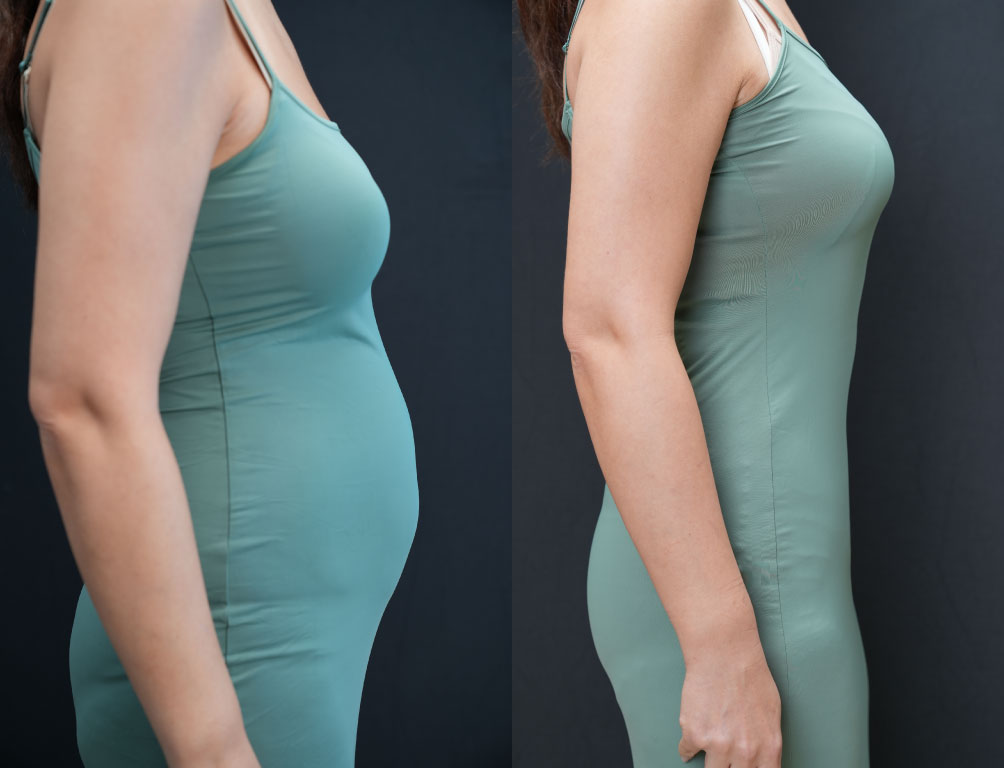 Dr. Mohammed Khamas - Before & After Results 2